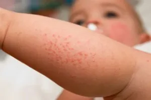 erupții cutanate infecțioase și alergice la copii