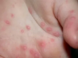 Fertőző és allergiás kiütések gyermekeknél