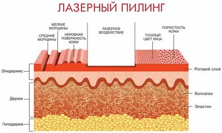 Лазерно почистване на лицето ефект, показания, противопоказания, ревюта