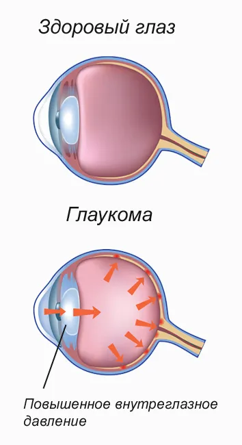 Cure pentru ochi glaucom picături, medicamente - tratament, simptome, prevenirea