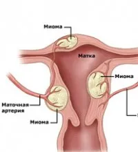 fibrom uterin tratamentul remedii populare