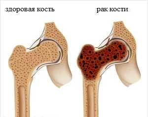 Melanomul osoase arata ca, tratament