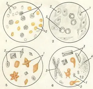 Examinarea microscopică a sedimentul urinar