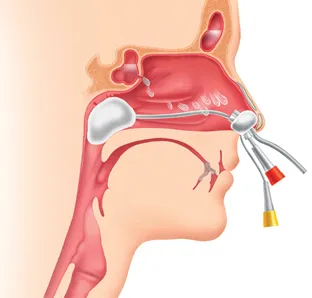 Klinikán cryo - méz - orrmelléküreg-gyulladás