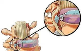 Metastazele în simptomele coloanei vertebrale, diagnosticarea, tratarea și eliminarea, prognosticul cursului bolii