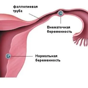 възможно да има извънматочна бременност ли е, здраво бебе