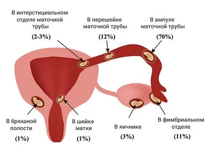 Pot salva o sarcina extrauterina șansele de fertila