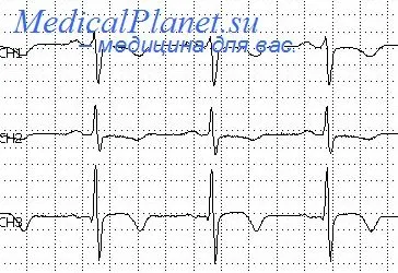 infarct miocardic Netransmuralny