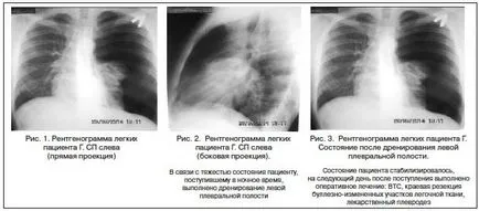 Strategia de tratament pneumotorax non-traumatice, în Vinarskaya
