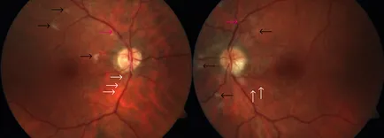 Ischemia a retinei - cauze, simptome si tratament