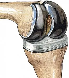подмяна на коляното операция