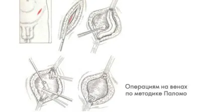 Chirurgia pentru Varicocelul la tipurile de bărbați și tehnici de modul de a face și cât de mult durează