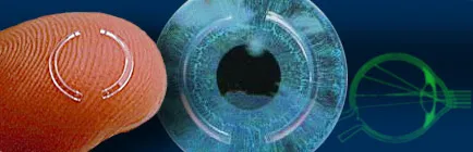 Хирургия за кератоконус, очите клиника - Ленар