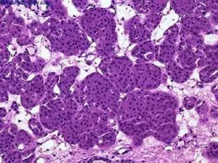 vese oncocytoma