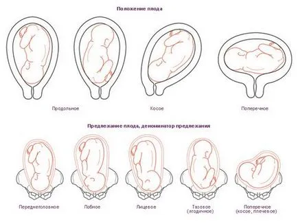 Определяне на седалищно предлежание плода сам