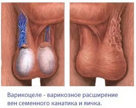 A fő oka a varicocele és kezelés, uflebologa