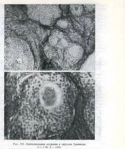 Brenner тумор - практика histologist