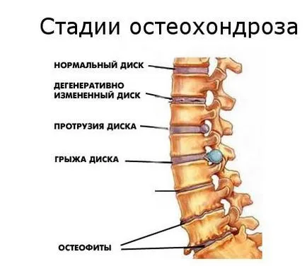 osteochondrosis fajták, típusok, és hogyan gyógyíthatók a betegségek