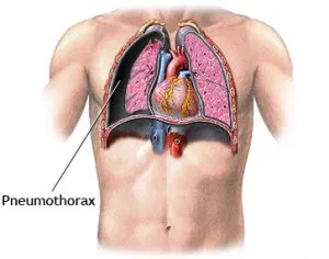 ghidurilor clinice pneumotorax, simptome și tratament