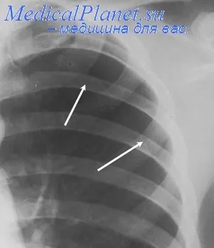 Pneumotorax intr-un nou-născut - tablou clinic, diagnostic, tratament