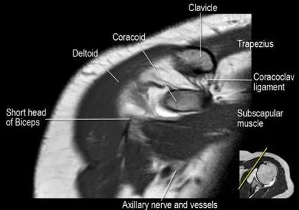 Umăr anatomie studiu comun folosind IRM