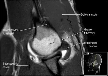 Umăr anatomie studiu comun folosind IRM