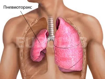 Пневмоторакс в детските симптоми, лечение, профилактика, причинява на болестта