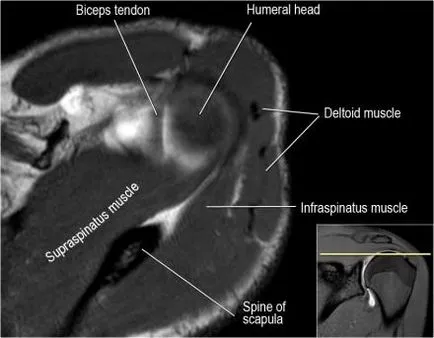 Umăr anatomie studiu comun folosind IRM