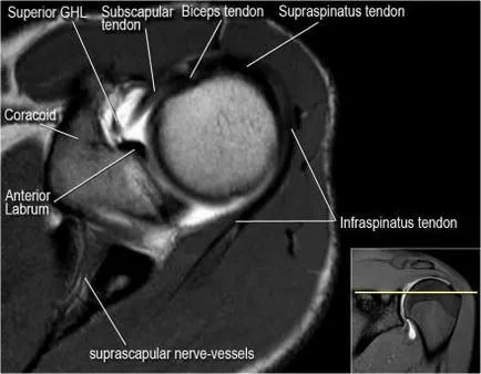 Umăr anatomie studiu comun folosind IRM