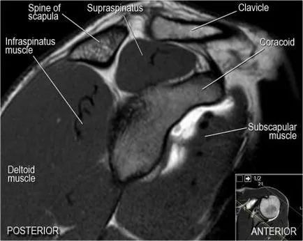 Umăr anatomie studiu comun folosind IRM