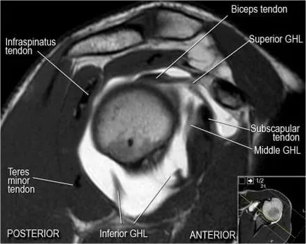 A vállízület anatómiai MRI vizsgálat