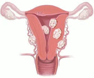 Perioada postoperatorie după miomectomie laparoscopica a uterului, conservatoare,