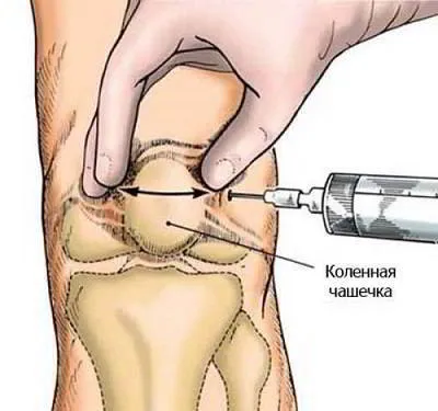 Артрит на коленните и раменните стави - симптоми и лечение