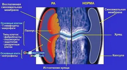 Артрит на коленните и раменните стави - симптоми и лечение