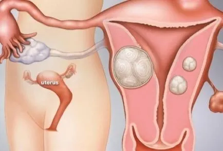 Perioada postoperatorie după miomectomie laparoscopica a uterului, conservatoare,