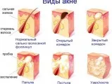 Cosurile în ureche (pe lobilor, in spatele urechilor, in jurul urechilor), cauze si tratament