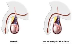 Előkészületek a here ciszták a nők, hogy lehetséges-e gyógyítani a ciszta here férfiaknál gyógyszerek szedése