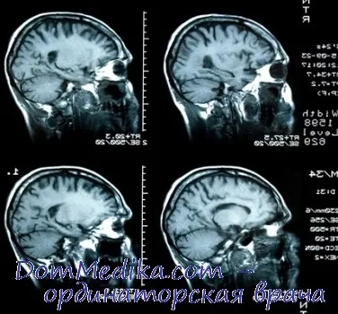 Причини за исхемичен инсулт - емболичен мозъчен инфаркт