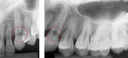 carii cervicale cauze si tratament (foto, video)