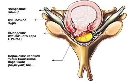 Proeminența cervicale semne coloanei vertebrale, simptome și tratament, gimnastica (video)