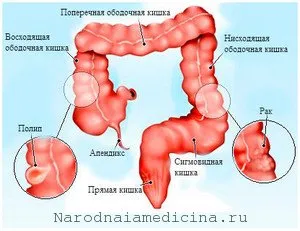 Cancerul cecului