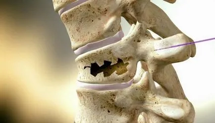 Reabilitarea după fractură a coloanei vertebrale