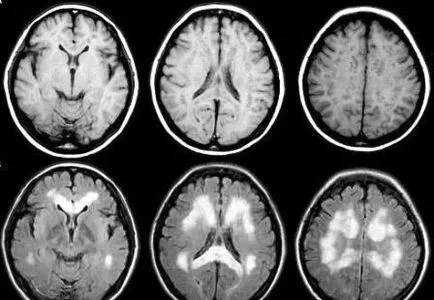 Milyen gyakran lehet csinálni egy agyi MRI