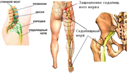 Седалищния нерв по време на бременност - лечение щипка