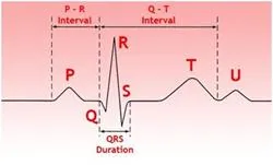 WPW-szindrómában az EKG