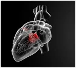 WPW-szindrómában az EKG