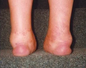 Tünetei arthritis psoriatica típus