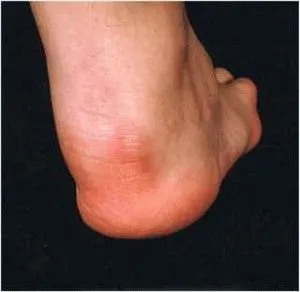 Tünetei arthritis psoriatica típus