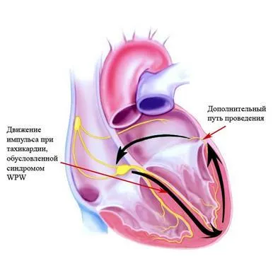 WPW-szindrómában az EKG