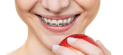 Cât de mulți trebuie să poarte aparat dentar pentru a corecta consiliere de specialitate muscatura